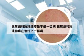 銀屑病和玫瑰糠疹是不是一類病 銀屑病和玫瑰糠疹在治療上一樣嗎