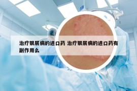 治療銀屑病的進口藥 治療銀屑病的進口藥有副作用么