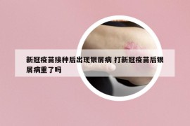 新冠疫苗接種后出現(xiàn)銀屑病 打新冠疫苗后銀屑病重了嗎