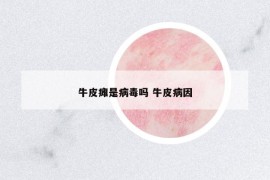 牛皮癱是病毒嗎 牛皮病因