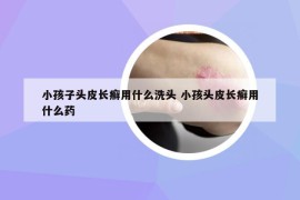 小孩子頭皮長(zhǎng)癬用什么洗頭 小孩頭皮長(zhǎng)癬用什么藥