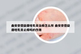 曲安奈德益康唑乳膏治癬怎么樣 曲安奈德益康唑乳膏止癢嗎的作用