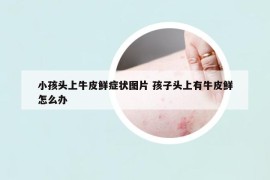 小孩頭上牛皮鮮癥狀圖片 孩子頭上有牛皮鮮怎么辦
