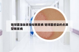 鏈球菌溶血素指標(biāo)銀屑病 鏈球菌感染的點(diǎn)滴型銀屑病