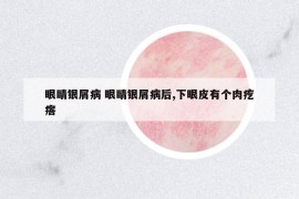 眼睛銀屑病 眼睛銀屑病后,下眼皮有個肉疙瘩