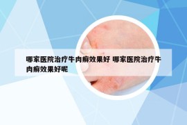 哪家醫(yī)院治療牛肉癬效果好 哪家醫(yī)院治療牛肉癬效果好呢