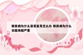 銀屑病為什么容易復發(fā)怎么辦 銀屑病為什么會越來越嚴重