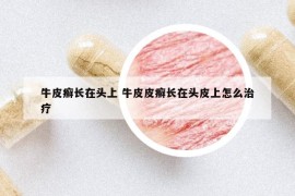 牛皮癬長(zhǎng)在頭上 牛皮皮癬長(zhǎng)在頭皮上怎么治療