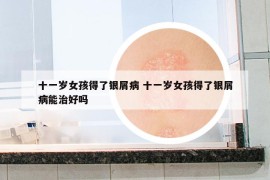十一歲女孩得了銀屑病 十一歲女孩得了銀屑病能治好嗎