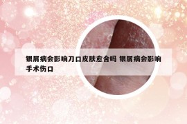 銀屑病會(huì)影響刀口皮膚愈合嗎 銀屑病會(huì)影響手術(shù)傷口