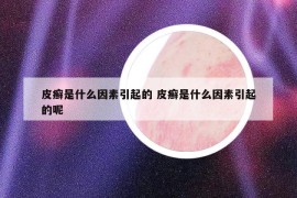 皮癬是什么因素引起的 皮癬是什么因素引起的呢