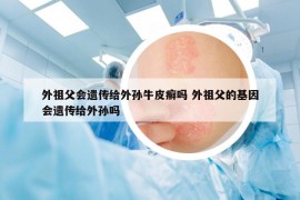 外祖父會(huì)遺傳給外孫牛皮癬嗎 外祖父的基因會(huì)遺傳給外孫嗎