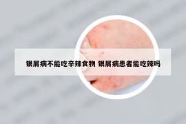 銀屑病不能吃辛辣食物 銀屑病患者能吃辣嗎
