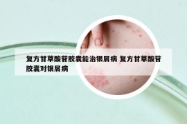 復方甘草酸苷膠囊能治銀屑病 復方甘草酸苷膠囊對銀屑病