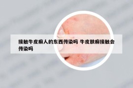 接觸牛皮癬人的東西傳染嗎 牛皮膚癬接觸會(huì)傳染嗎
