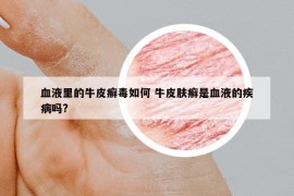 血液里的牛皮癬毒如何 牛皮膚癬是血液的疾病嗎?