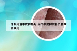 什么藥治牛皮鮮最好 治療牛皮鮮有什么特效藥草藥