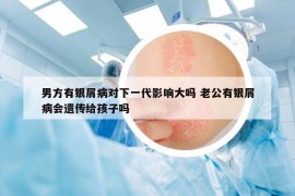 男方有銀屑病對(duì)下一代影響大嗎 老公有銀屑病會(huì)遺傳給孩子嗎