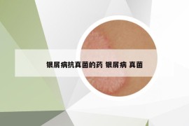 銀屑病抗真菌的藥 銀屑病 真菌