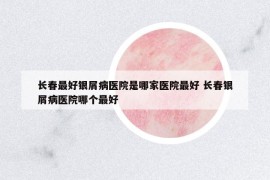長春最好銀屑病醫(yī)院是哪家醫(yī)院最好 長春銀屑病醫(yī)院哪個最好