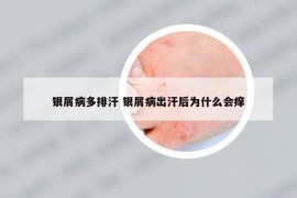 銀屑病多排汗 銀屑病出汗后為什么會(huì)癢