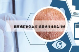 銀屑病打針怎么打 銀屑病打針怎么打好