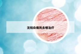 沈陽白癜風(fēng)去哪治療