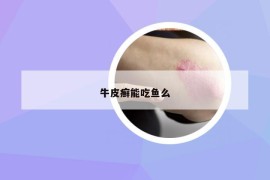 牛皮癬能吃魚么
