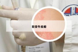 軟膏牛皮癬