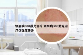 銀屑病308激光治療 銀屑病308激光治療儀強(qiáng)度多少