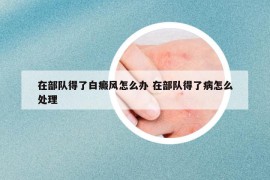 在部隊(duì)得了白癜風(fēng)怎么辦 在部隊(duì)得了病怎么處理