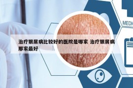 治療銀屑病比較好的醫(yī)院是哪家 治療銀屑病那家最好