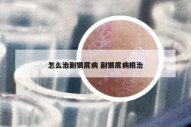 怎么治副銀屑病 副銀屑病根治