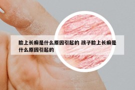 臉上長癬是什么原因引起的 孩子臉上長癬是什么原因引起的