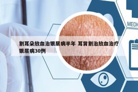 割耳朵放血治銀屑病半年 耳背割治放血治療銀屑病30例