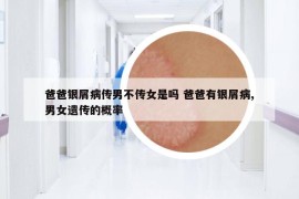 爸爸銀屑病傳男不傳女是嗎 爸爸有銀屑病,男女遺傳的概率