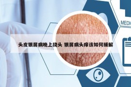 頭皮銀屑病晚上撓頭 銀屑病頭癢該如何緩解