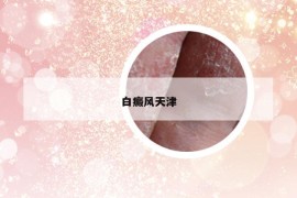 白癜風(fēng)天津