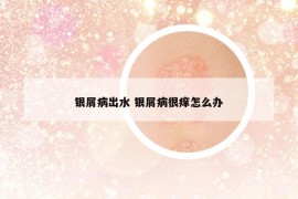 銀屑病出水 銀屑病很癢怎么辦