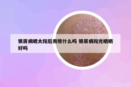 銀屑病曬太陽(yáng)后用擦什么嗎 銀屑病陽(yáng)光曬曬好嗎
