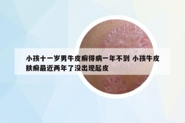 小孩十一歲男牛皮癬得病一年不到 小孩牛皮膚癬最近兩年了沒出現(xiàn)起皮