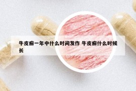 牛皮癬一年中什么時(shí)間發(fā)作 牛皮癬什么時(shí)候長(zhǎng)