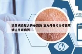 銀屑病輸復(fù)方丹參滴液 復(fù)方丹參片治療銀屑病進(jìn)行期病例