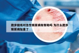 跑步鍛煉對急性銀屑病有幫助嗎 為什么跑步銀屑病加重了