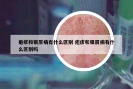 皰疹和銀屑病有什么區(qū)別 皰疹和銀屑病有什么區(qū)別嗎