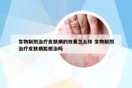 生物制劑治療皮膚病的效果怎么樣 生物制劑治療皮膚病能根治嗎