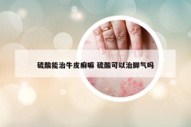 硫酸能治牛皮癬嘛 硫酸可以治腳氣嗎
