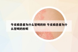 牛皮癬患者為什么管喝奶粉 牛皮癬患者為什么管喝奶粉呢