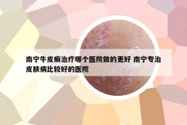南寧牛皮癬治療哪個(gè)醫(yī)院做的更好 南寧專治皮膚病比較好的醫(yī)院