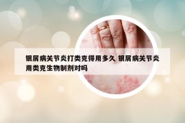 銀屑病關(guān)節(jié)炎打類(lèi)克得用多久 銀屑病關(guān)節(jié)炎用類(lèi)克生物制劑對(duì)嗎